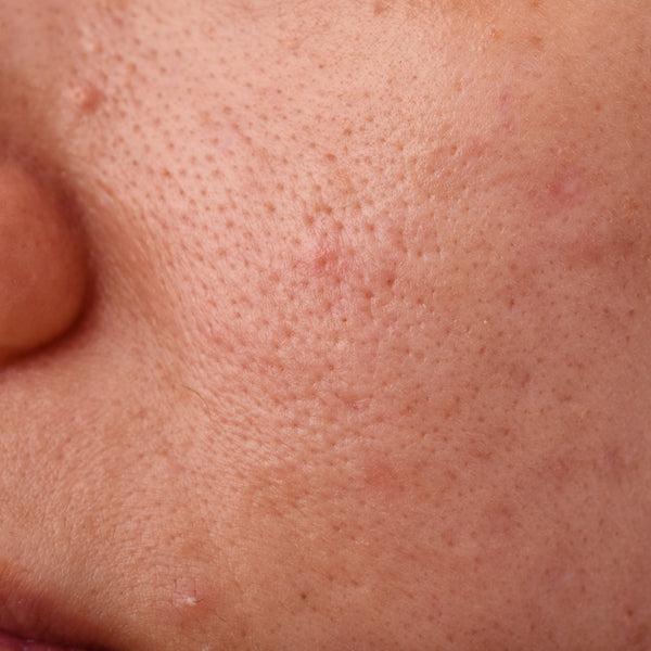 5 Best Ways To Fight Clogged Pores At Home Treatments Dr Zenovia