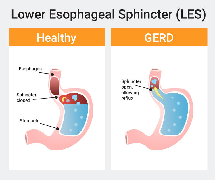 How To Prevent Acid Reflux And Gerd Medcline