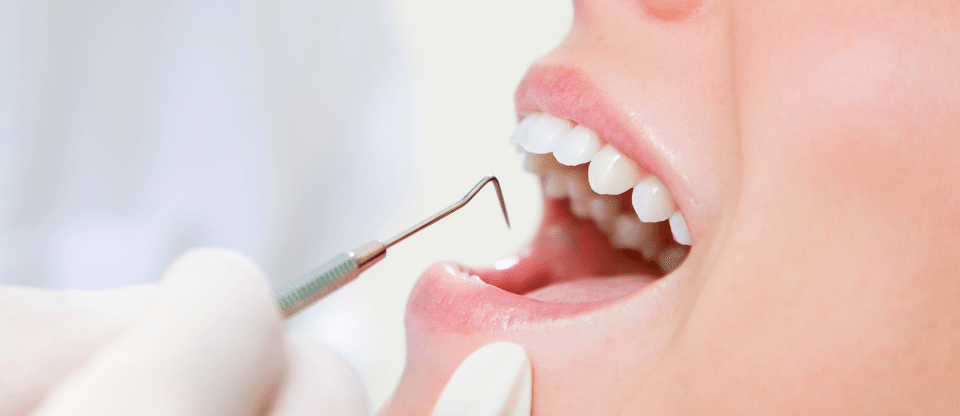 How To Remove Tartar From Your Teeth Without A Dentist Sonisk Sonisk