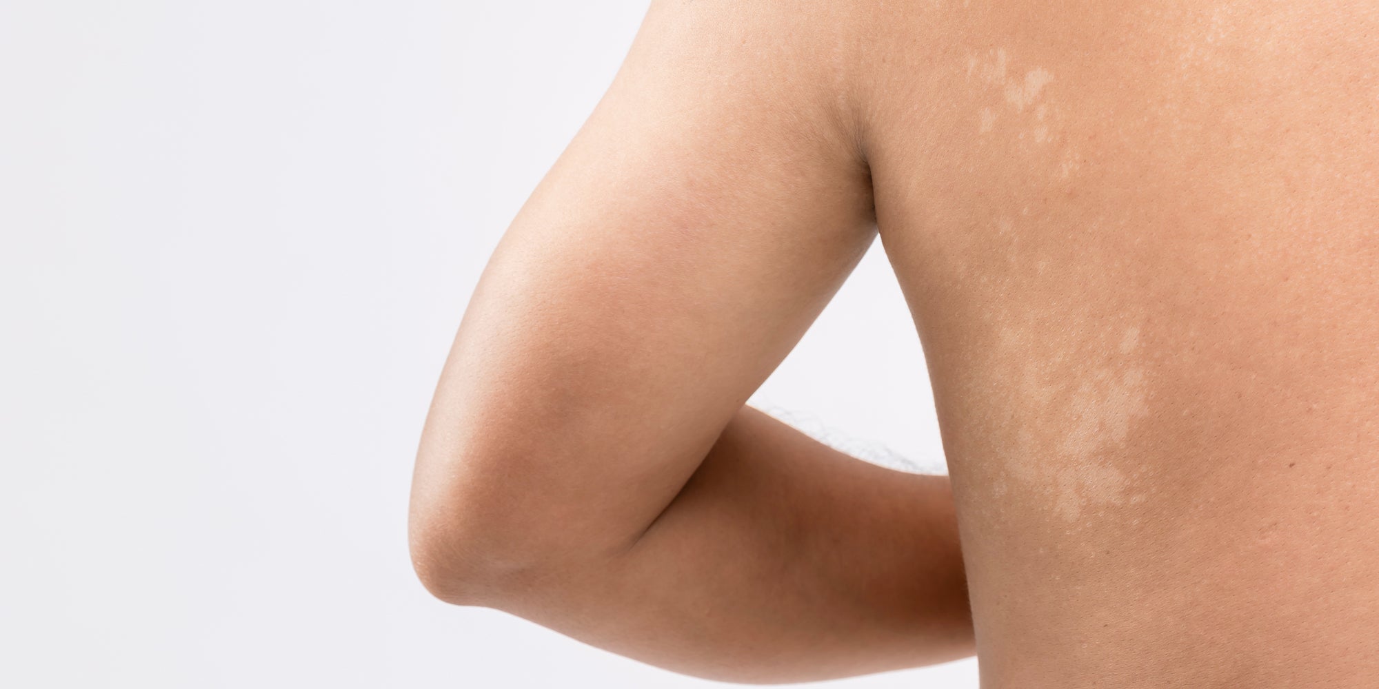 Comment Soigner Une Mycose Vulvaire Buccale Ungueale Puressentiel