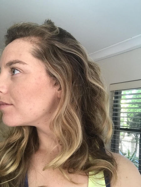 Curing My Pcos Hair Loss Pcos To Wellness