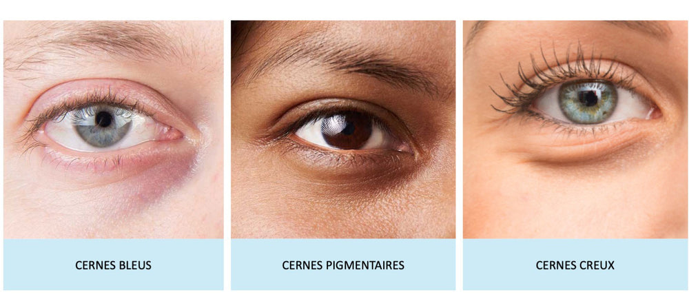 Cernes Quels Sont Les Traitements Les Plus Efficaces