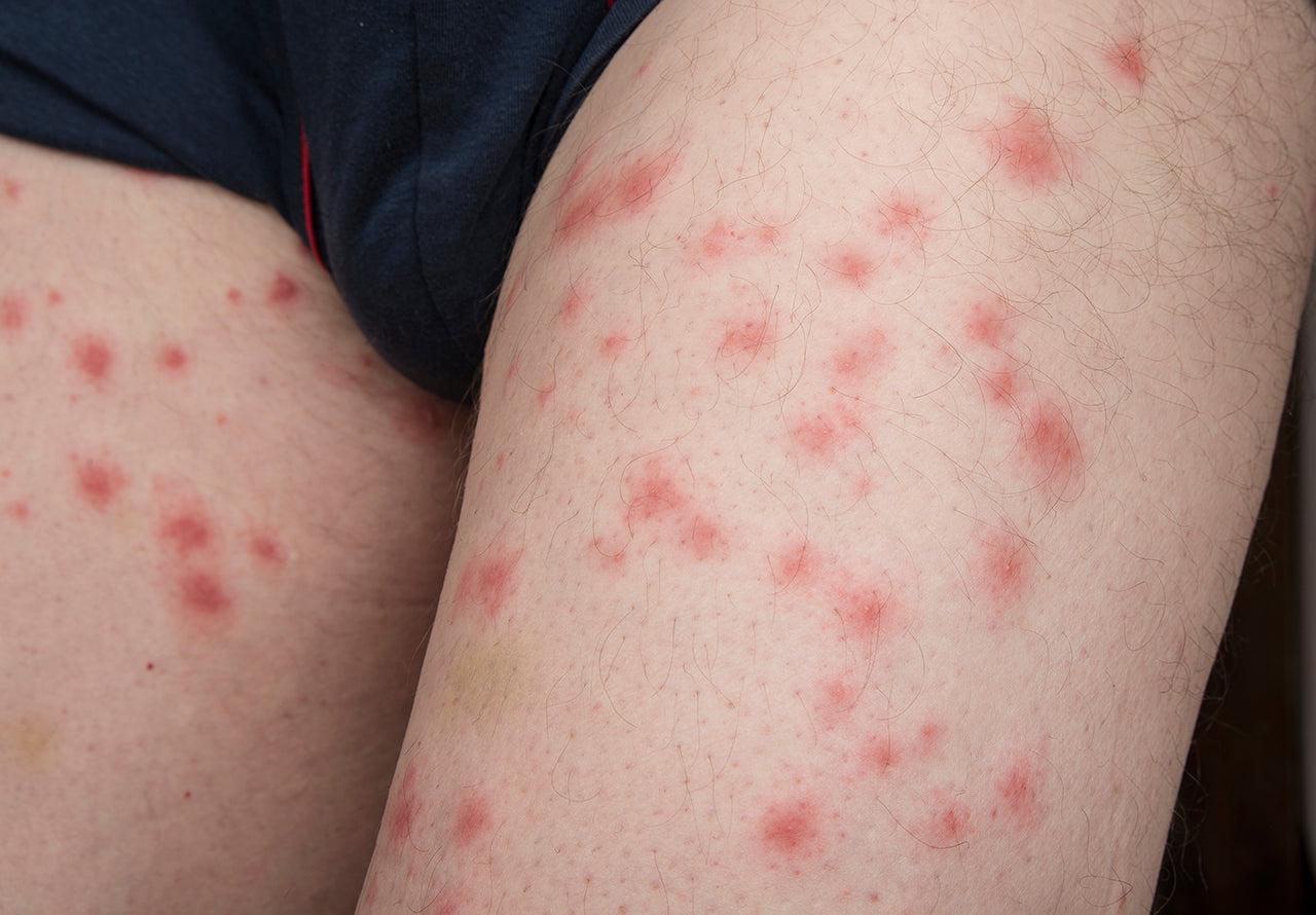 How Do Bed Bug Bites Look Like Protect Pest Control