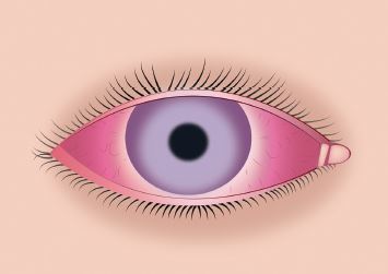 Come Prevenire E Curare Gli Occhi Rossi Dopo L Estensione Delle Ciglia Conny Lashes