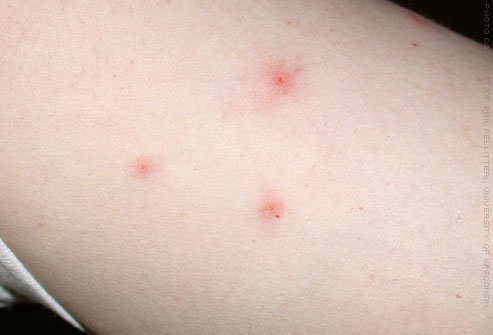 Worried About A Bite Check Out Pictures Of Bed Bug Bites Zappbug