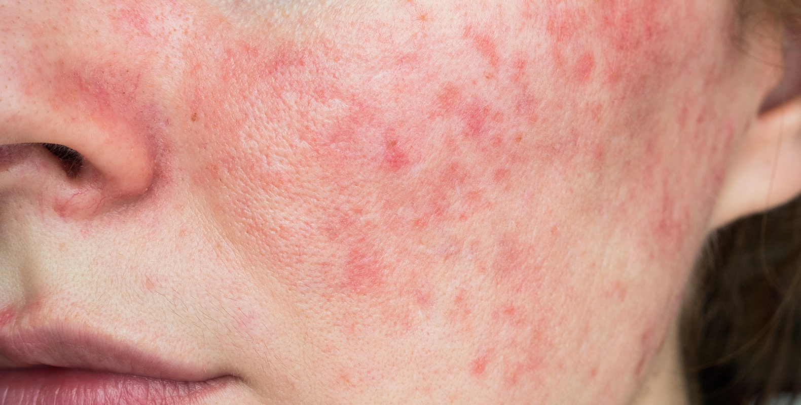 How To Treat Facial Rosacea Correctly Doctor Mi