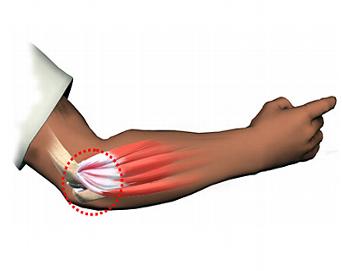 Gomito Del Tennista Sintomi Noacademy