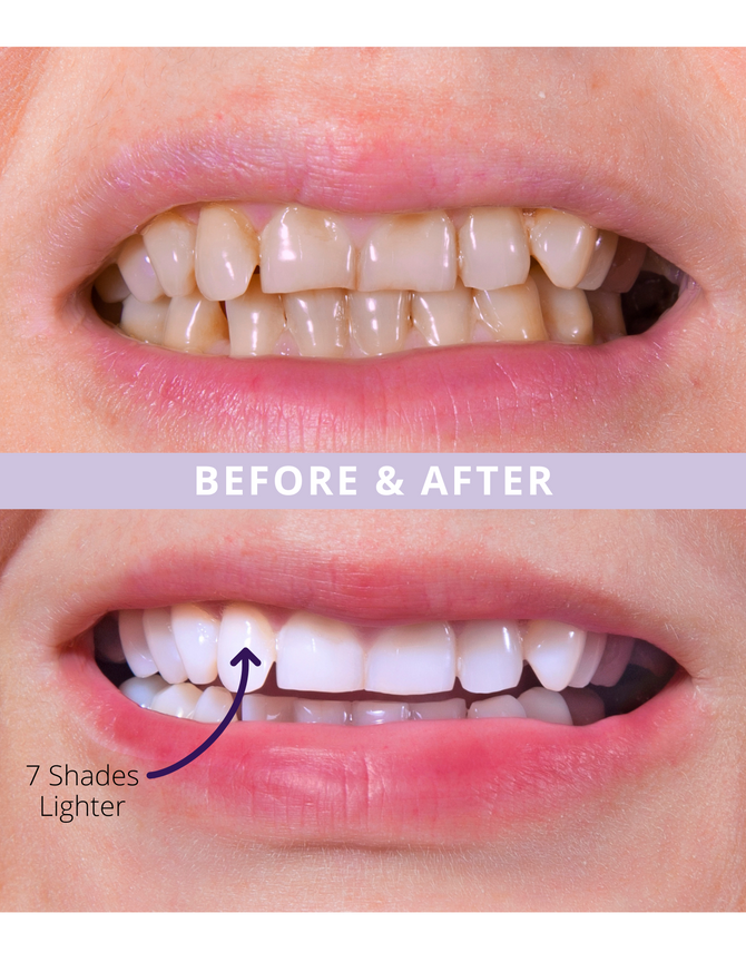Magic Teeth Whitening Masks Elims