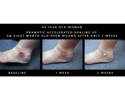 wound healed by grounding