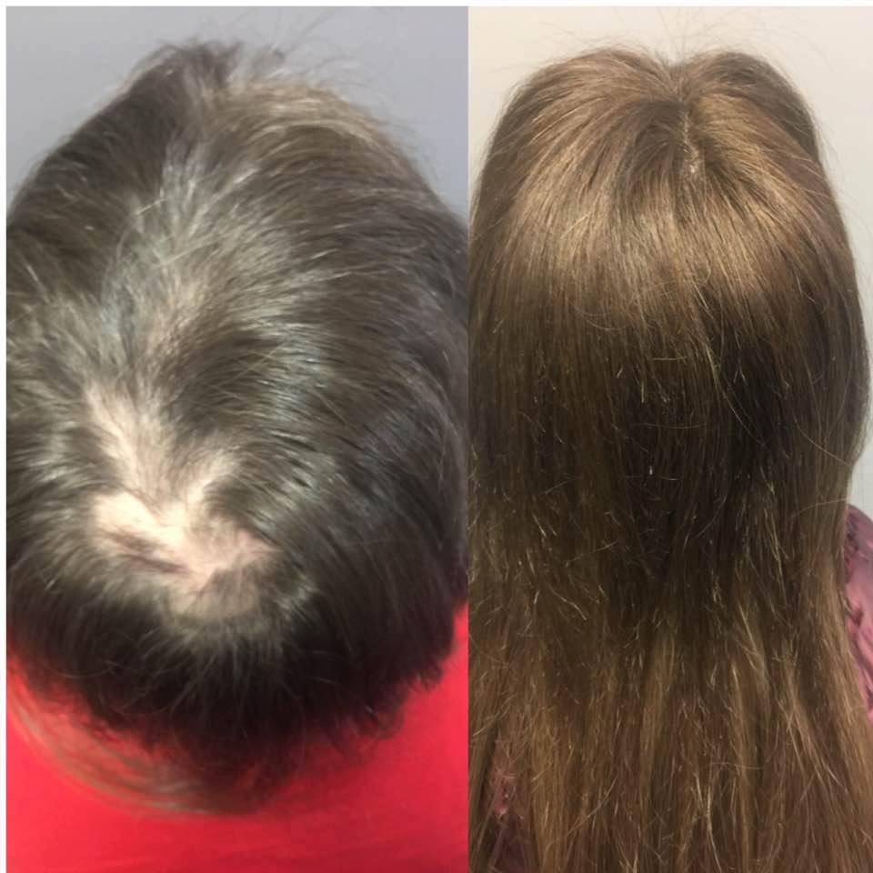 Lupus Alopecia Hair Loss Noellesalon