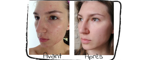 Mon Histoire Acne Arret Pilule Diane 35 Consultations Medicales Et L Oree Des Savons