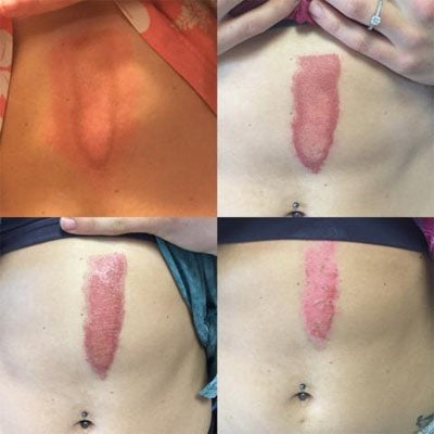 How To Treat Rope Burn Heal Care For Your Hands With Wod Welder