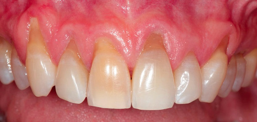 E Cigs And Oral Health Zak Dental Family Dentistry Cosmetic Dentistry