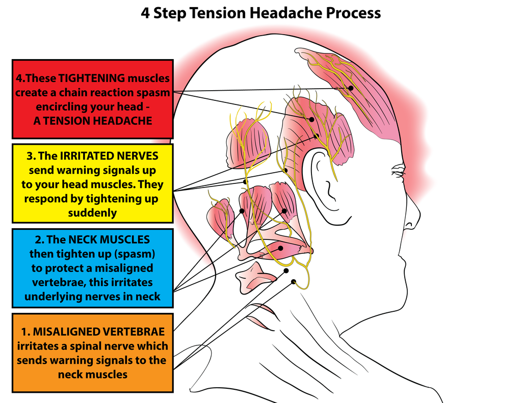Tension Type Headache Osteopathy Prescriptive Exercise By Osteopaths