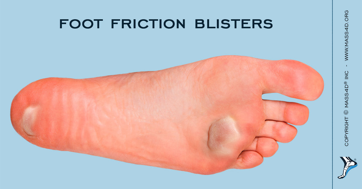 What Are Foot Friction Blisters Mass4d Insoles Mass4d Foot Orthotics