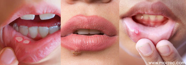 Kiss Winter Cold Sores Fever Blisters Goodbye Feelgood Health