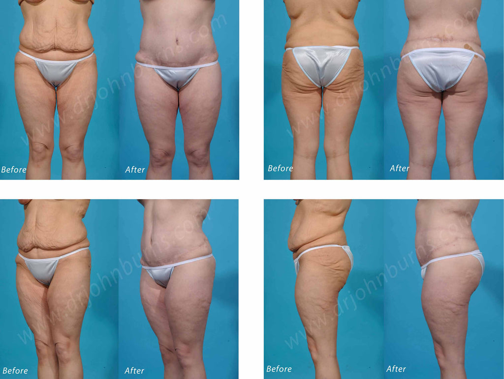Circumferential Tummy Tuck Abdominoplasty Lower Body Lift Dr John Burns