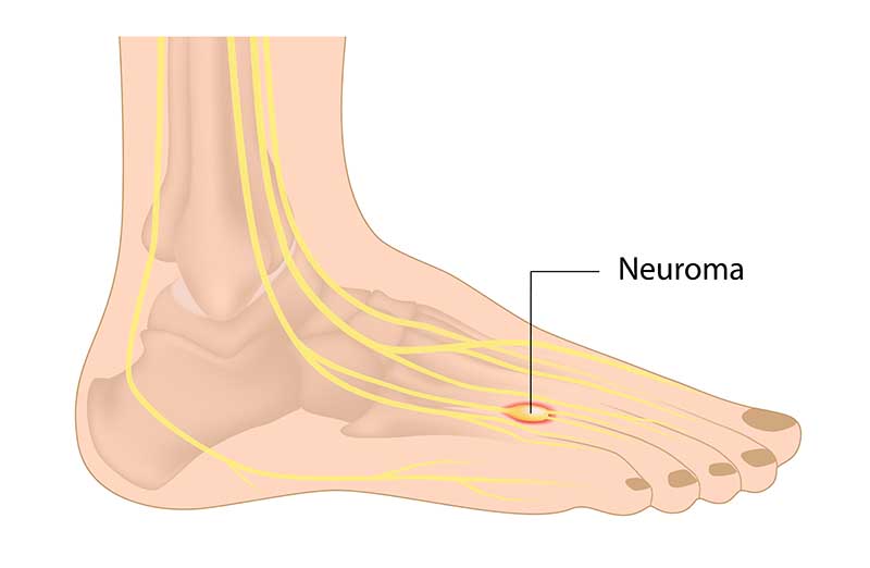 Injury Advice Mortons Neuroma Enertor