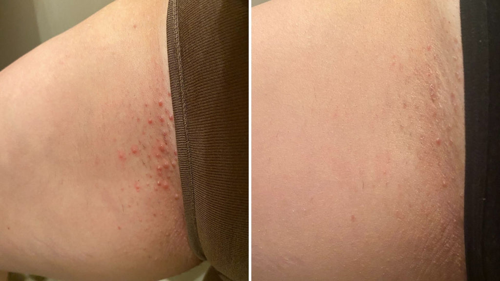 The Girlfriends Guide To Treating Razor Burn In 5 Steps Bushbalm