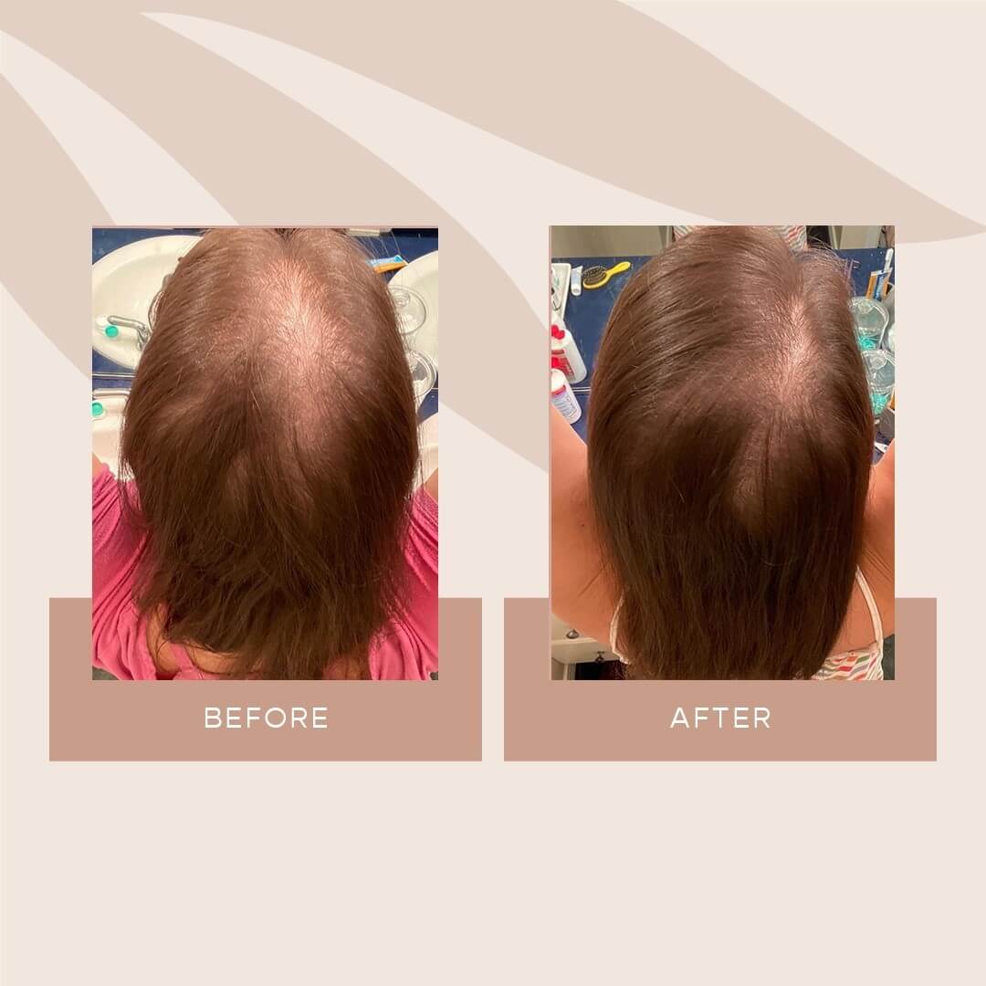 These 12 Medications Might Cause Hair Loss