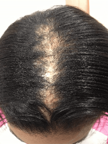 How To Prevent Hair Loss In Black Women Hairzing