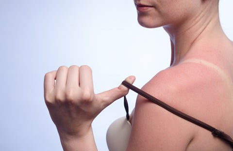 Sunburn Blisters Signs Symptoms Treatment For Sunburn Bubbles