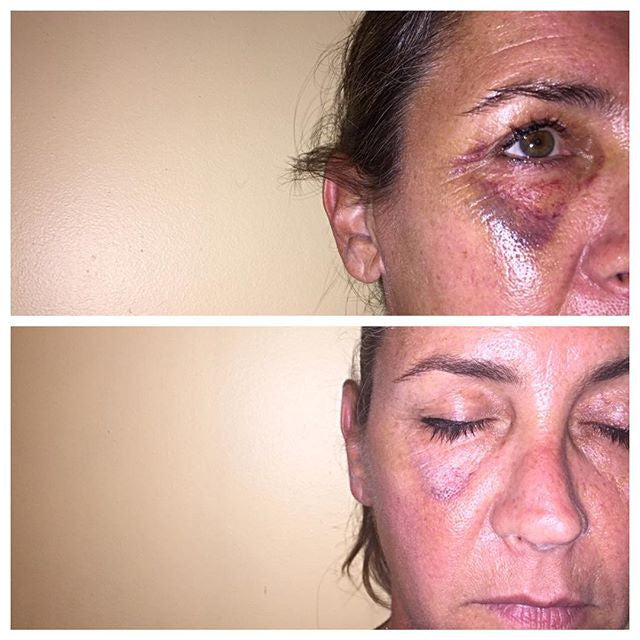 How To Heal A Bruise Faster Seaside Medical Technologies