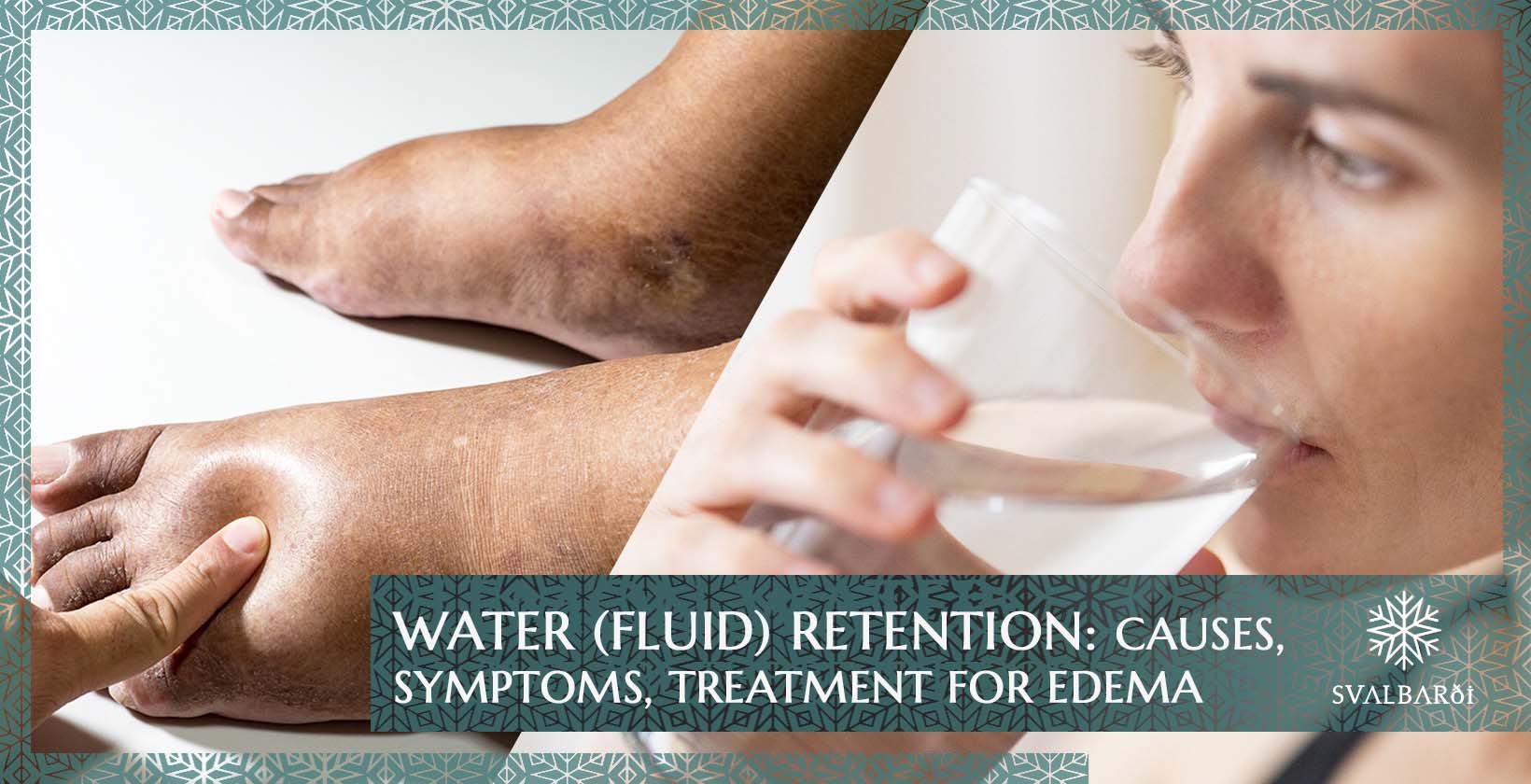 Water Fluid Retention Causes Symptoms Treatment For Edema Svalbardi Polar Iceberg Water