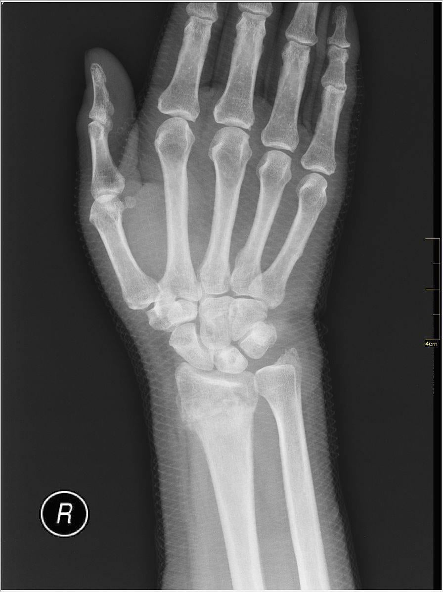 Using A Support After Wrist Fracture Essential Wellness