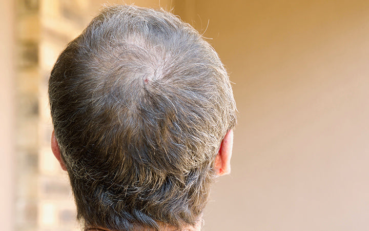 8 Types Of Scalp Folliculitis Ways To Get Rid Of Them Skinkraft