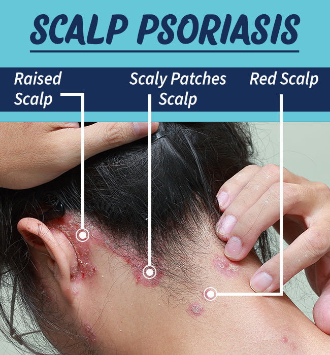 What Causes Scalp Pain How To Treat It Skinkraft