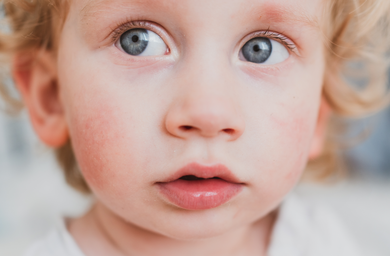 What Is Slapped Cheek Syndrome Nature S Baby Organics Nature S Baby Organics