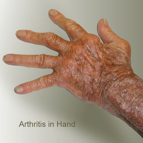 Arthritis Hands How To Relieve Arthritis Hand Joint Finger Pain Therapygloves Com