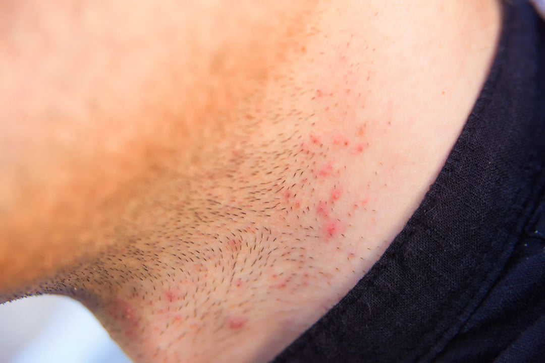 Razor Burn How To Tackle Razor Bumps Ingrowns