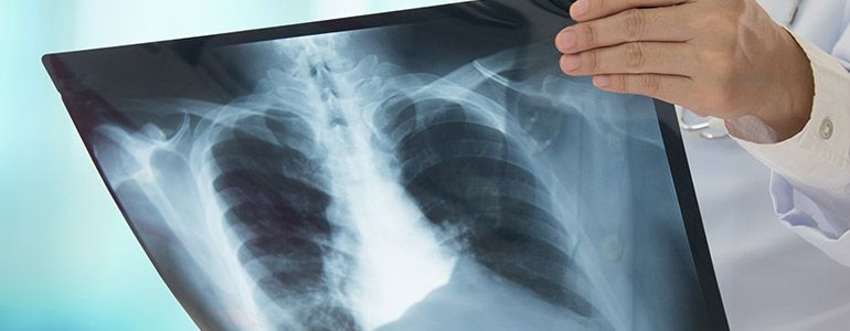 Broken Ribs Management Heal The Pain With Rib Braces Everyday Medical