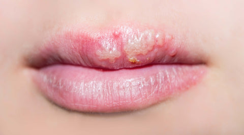 How To Get Rid Of A Cold Sore In 3 Days Pro Blo Group