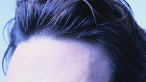 طرق نمو الشعر في مقدمة الرأس