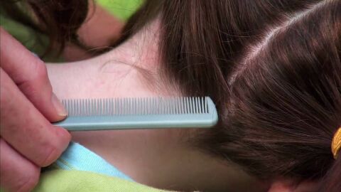 كيف يظهر القمل في الشعر