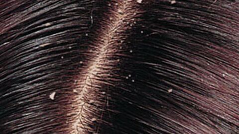 علاج قشرة الشعر الجاف