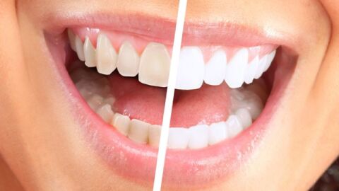 هل إزالة الجير من الأسنان مؤلم