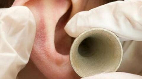 علاج ضعف السمع بالخلايا الجذعية