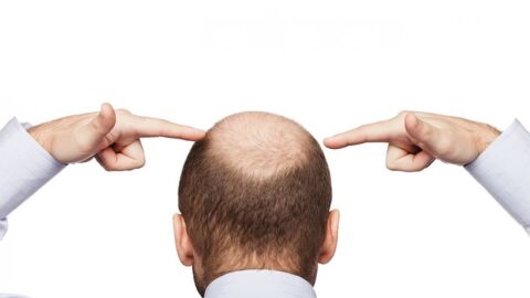 طرق معالجة تساقط الشعر عند الرجال