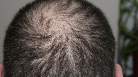 علاج تساقط الشعر وتكثيفه