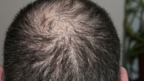 ما سبب تساقط الشعر عند الرجال