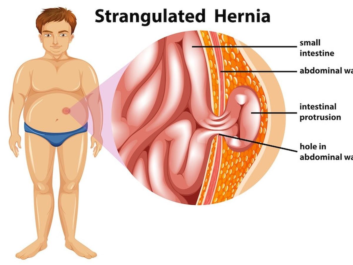 Apa Itu Hernia Ketahui Pengertian Macam Penyebab Gejala Dan Pengobatannya Ragam Bola Com