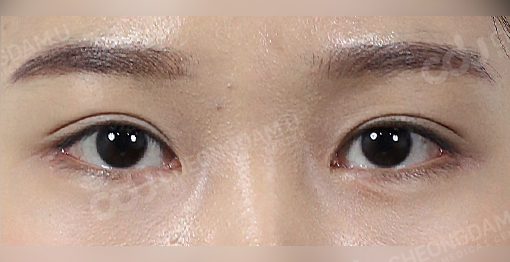 bigger eye surgery korea