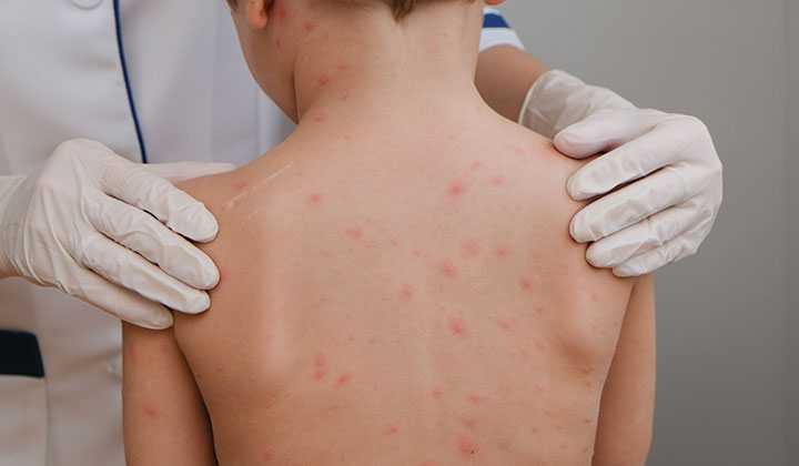 Hautausschlag Was Hilft Bei Pusteln Co Multilind