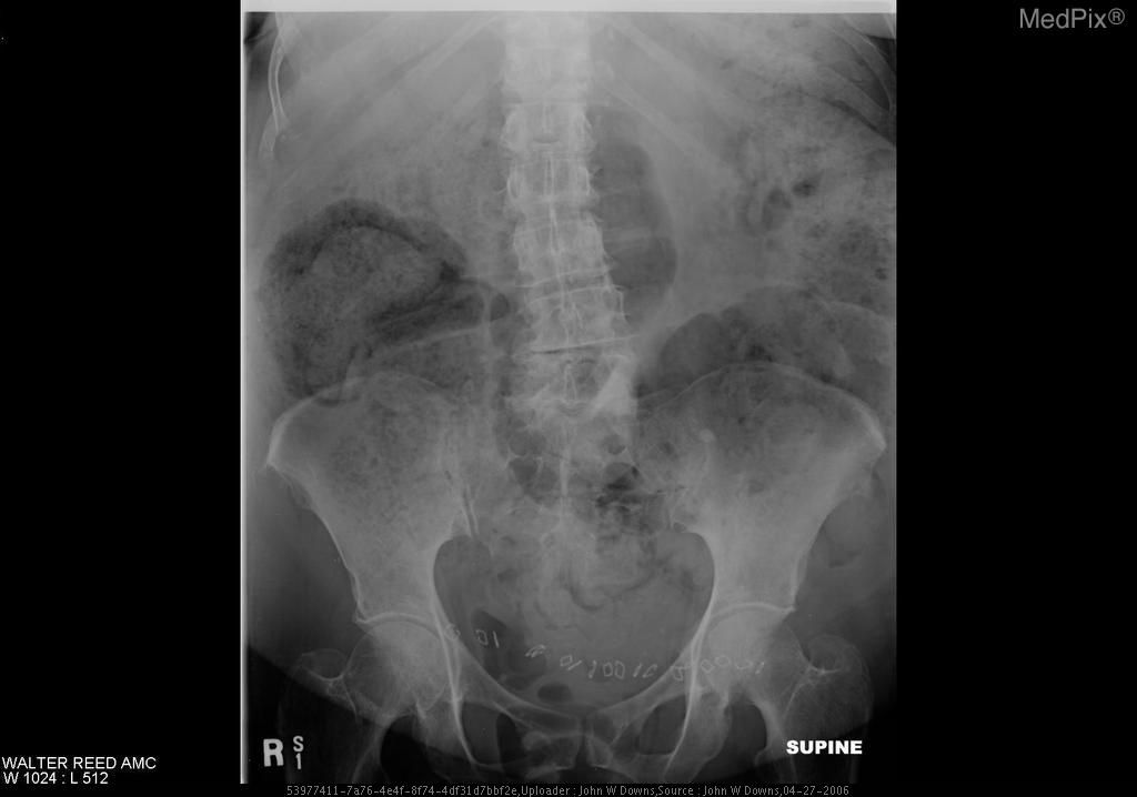 Medpix Case Toxic Megacolon