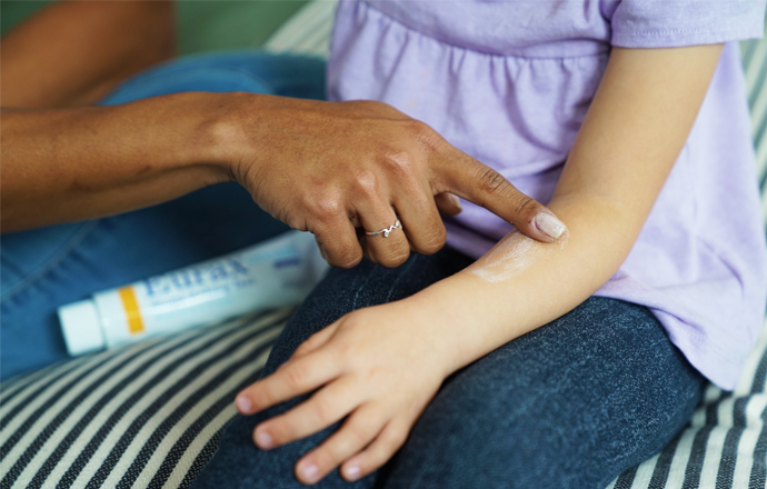 Treatment Of Chickenpox Tips Advice Eurax