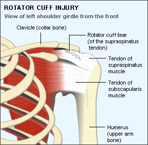 rotator cuff tear
